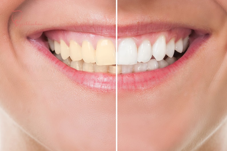 دندانپزشکی زیبایی چیست ؟