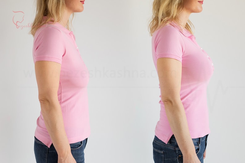breast-augmentation-pezeshkashna-two.jpg