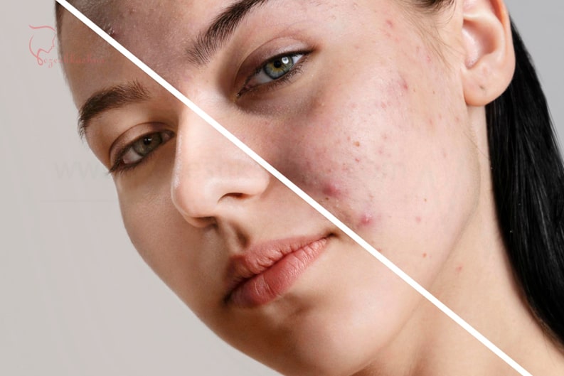 acne-treatment-pezeshkashna-two.jpg